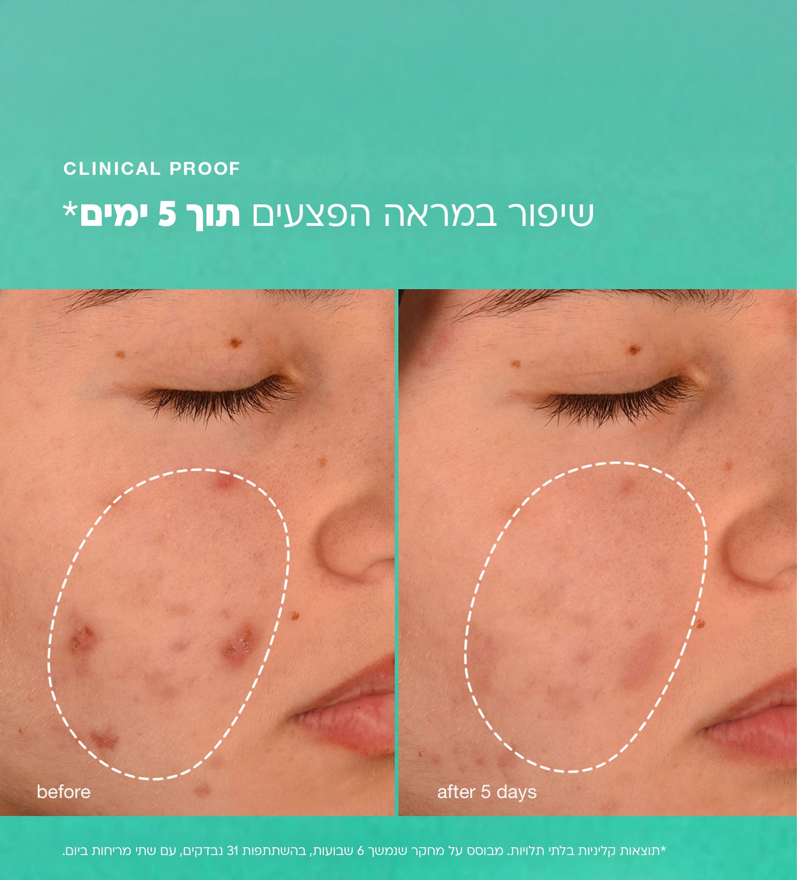 ברייק אאוט ביוטיק לחות טיפולית